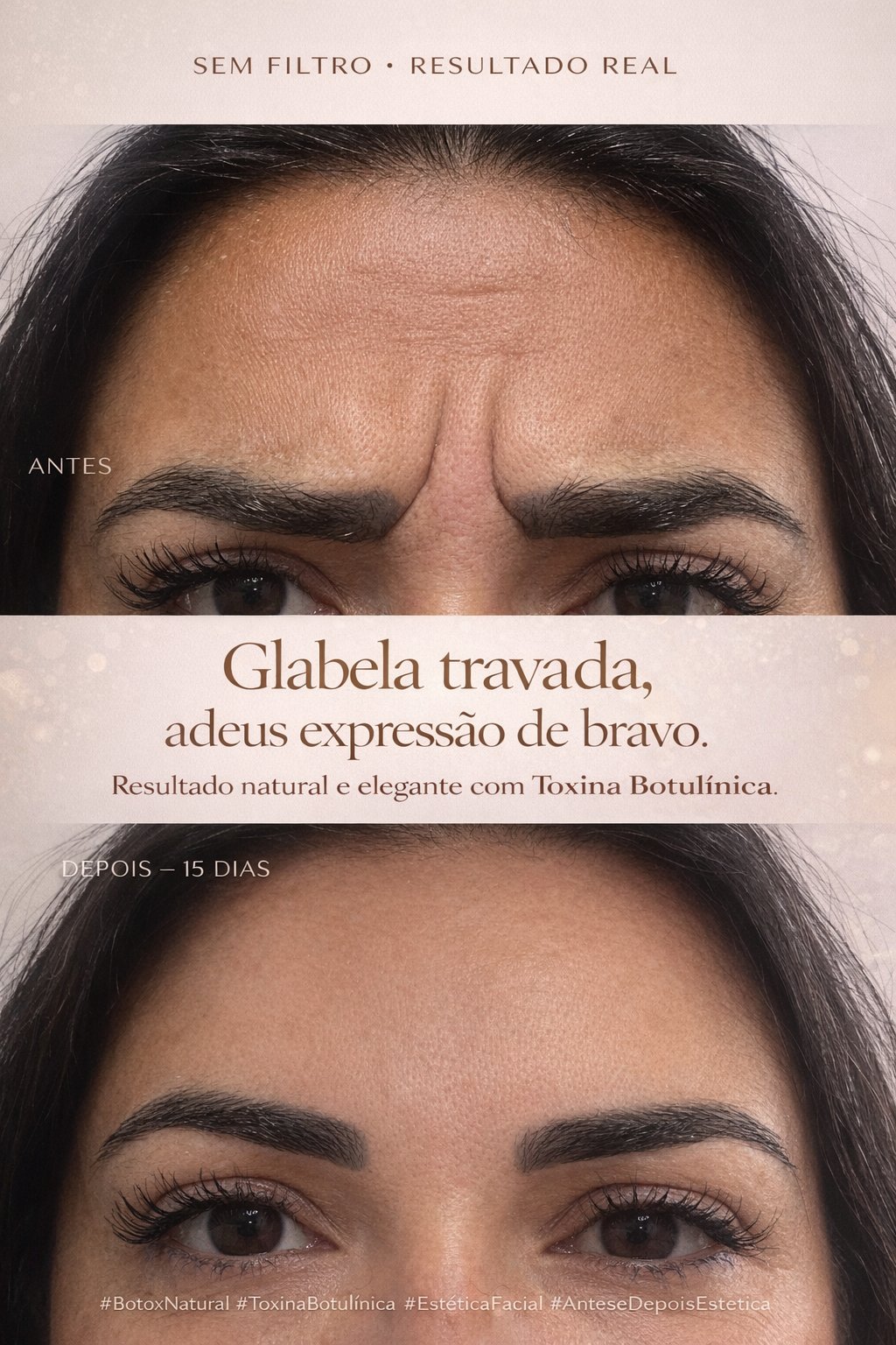 Resultado real - Glabela travada com Toxina Botulínica - Antes e Depois